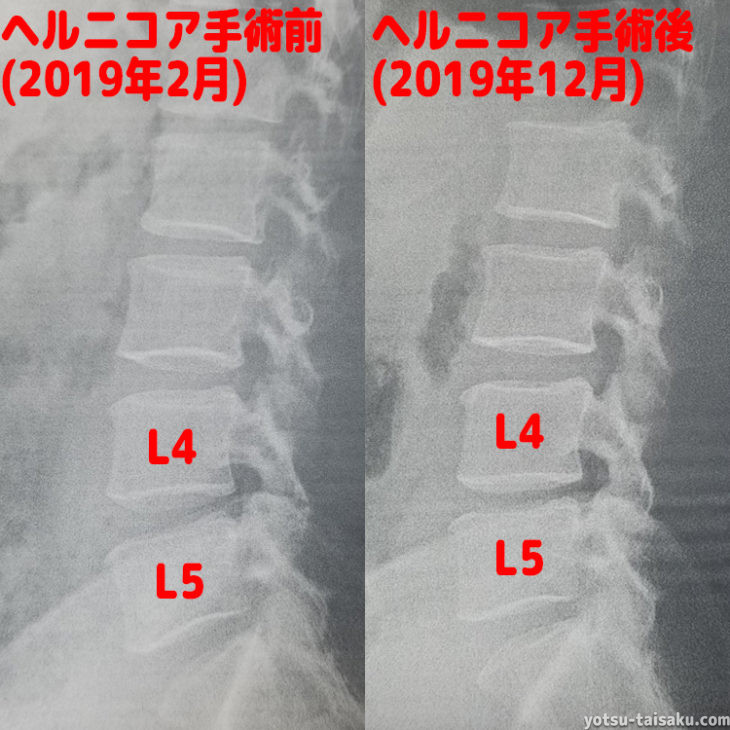 ヘルニコア手術後(6カ月)レントゲン画像比較