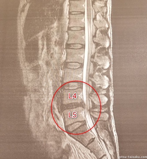 ヘルニコア術後4カ月目MRI画像